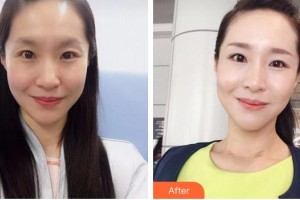 浏阳康美医疗美容门诊部邹笑寒整形价格表附嗨体去颈纹案例展示