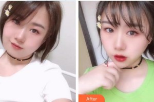 张波整形价格表附埋线提升案例展示