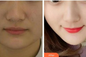 吴俊勇整形价格表附埋线提升案例展示