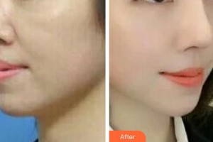 青州市人民医院美容科张炳泰整形价格表附紧肤案例展示