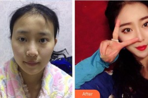 王衡健整形价格表附鼻部综合案例展示