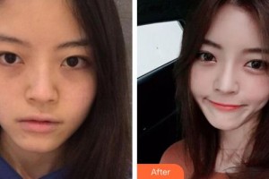 整形价格表附	项目分类	鼻部整形案例展示