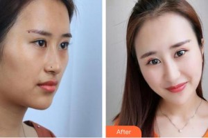 芮昊整形价格表附鼻部综合案例展示