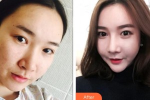 戴玉琳整形价格表附自体软骨垫鼻尖案例展示