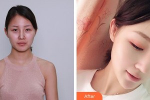 王善良整形价格表附硅胶隆鼻案例展示