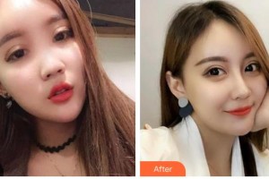 广州市越秀区妇幼保健院整形美容科江肖兴整形价格表附鼻部综合案例展示