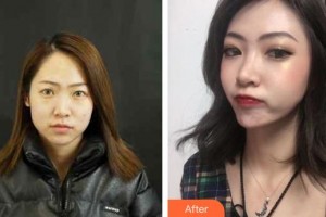 整形价格表附鼻部综合案例展示