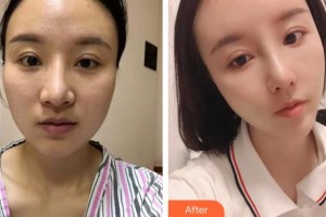 都匀利美康医疗美容门诊部张会英整形价格表附耳软骨复合隆鼻案例展示