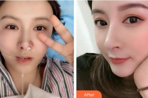 整形价格表附鼻部综合案例展示