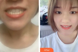 楚雄庞氏口腔门诊部高恩峰整形价格表附牙齿隐形矫正案例展示