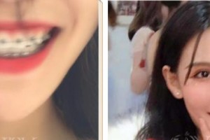 西藏阜康医院口腔科刘瑞楠整形价格表附美白贴片案例展示