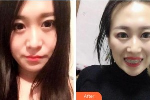 西藏阜康医院口腔科范贇韬整形价格表附金属托槽矫正案例展示