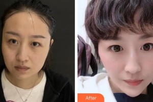 首都医科大学附属复兴医院整形美容中心高尚整形价格表附埋线提升案例展示