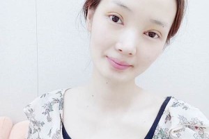 山东集美整形医院双眼皮手术果展示 附收费标准