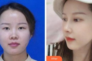 盛京医院滑翔分院医疗整形美容科王宇令整形价格表附肋软骨隆鼻案例展示