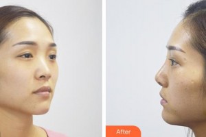 酒泉医学整形美容门诊部杨艳整形价格表附假体隆鼻案例展示