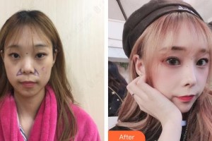 贾治兰整形价格表附鼻部综合案例展示