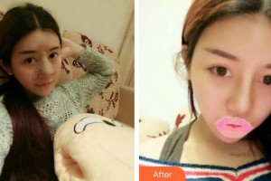 平凉康美医疗美容门诊部孙小虎整形价格表附耳软骨复合隆鼻案例展示