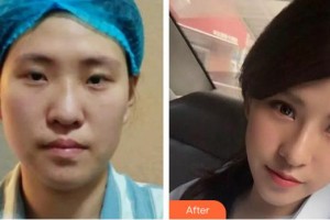 酒泉医学整形美容门诊部高俊整形价格表附膨体隆鼻案例展示