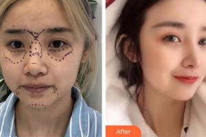 中航工业三六四医院医疗美容科辛华整形价格表附鼻部综合案例展示