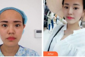 南海华美整形美容医院莫冰冰整形价格表附假体隆鼻案例展示