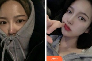 河间丽达医疗美容诊所王卫军整形价格表附鼻部综合案例展示