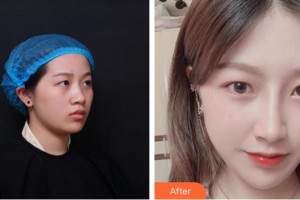 揭阳华美整形美容医院欧东辉整形价格表附肋软骨隆鼻案例展示