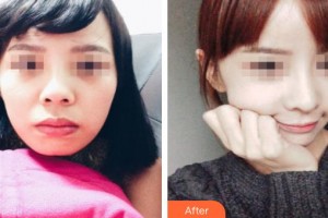 新泰侨艺外科美容诊所杜继珍整形价格表附鼻部综合案例展示