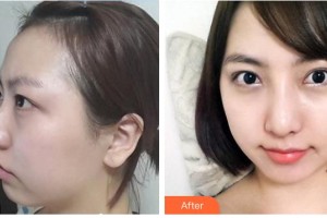 钟晓整形价格表附鼻骨矫正案例展示