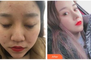 溧阳智多星医疗美容门诊部宋海涛整形价格表附鼻修复案例展示