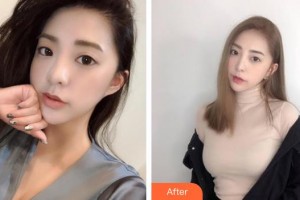 成武县人民医院医学美容科张凌云整形价格表附鼻部综合案例展示