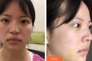 逢宝峰整形价格表附垫鼻基底案例展示