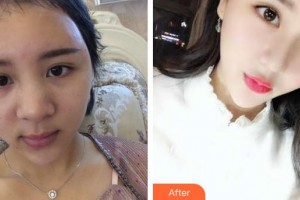 太仓仁慈医院整形美容中心朱立群整形价格表附肋软骨隆鼻案例展示