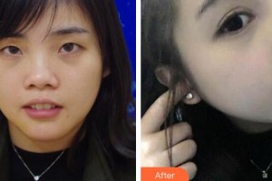 燕小丽整形价格表附鼻部综合案例展示