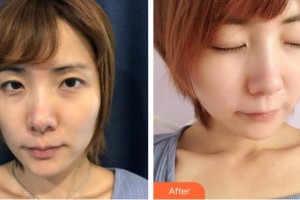 金乡县人民医院医学美容科张娅整形价格表附E光嫩肤案例展示