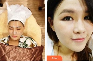 许成芳整形价格表附光子嫩肤案例展示