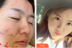 李均友整形价格表附红蓝光祛痘案例展示