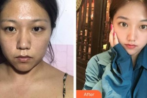 凌宵志整形价格表附激光祛斑案例展示