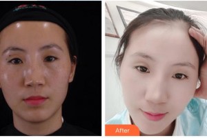 李建辉整形价格表附激光祛斑案例展示