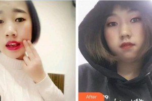 张少武整形价格表附根管调节案例展示