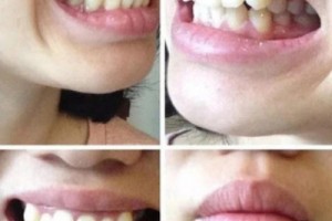西安中诺口腔医院评价？牙齿矫正成功案例分享！