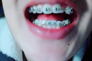 西宁医院牙科收费价目表｜附牙齿矫正经历