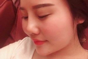 深圳北大医院美容科膨体隆鼻好吗？真实案例分享！
