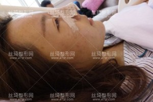 上海美赋医疗美容医院怎么样 ？肋骨隆鼻日记|医生推荐