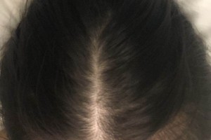 杭州新生毛发医院种植头发果如何？附案例图测评！
