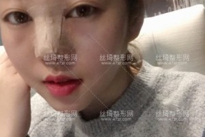 上海安缦医美隆鼻怎么样？术前术后经验分享！